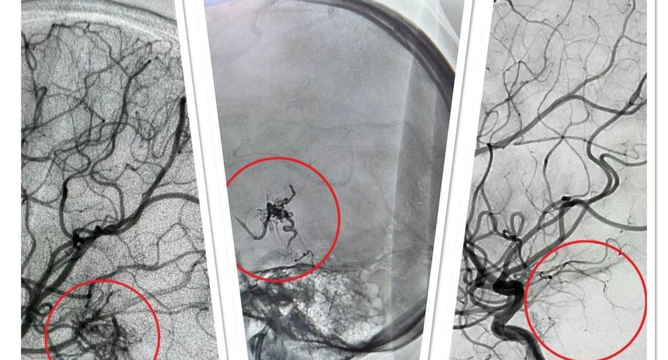 Врачи Центра Рошаля спасли 17-летнюю девушку от кровоизлияния в мозг