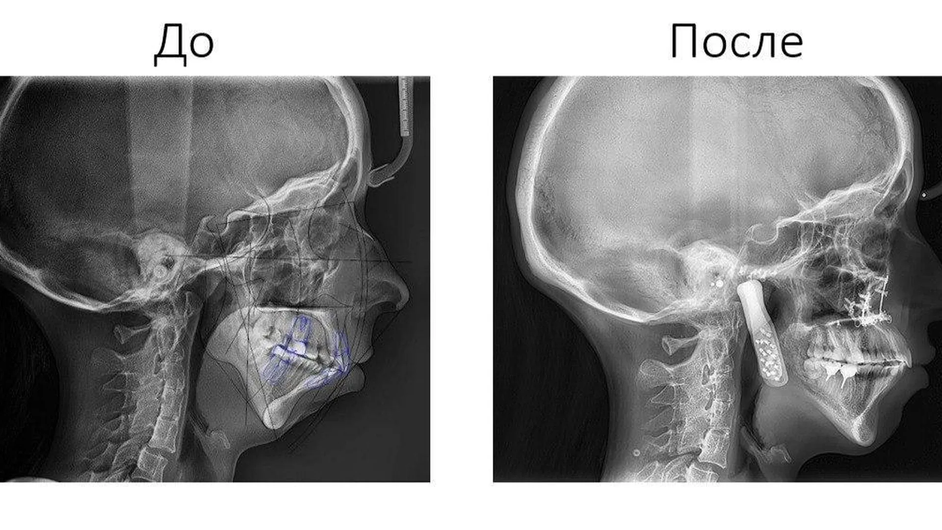 Хирурги МОНИКИ 12 часов восстанавливали челюсть пациентке по 3D-модели