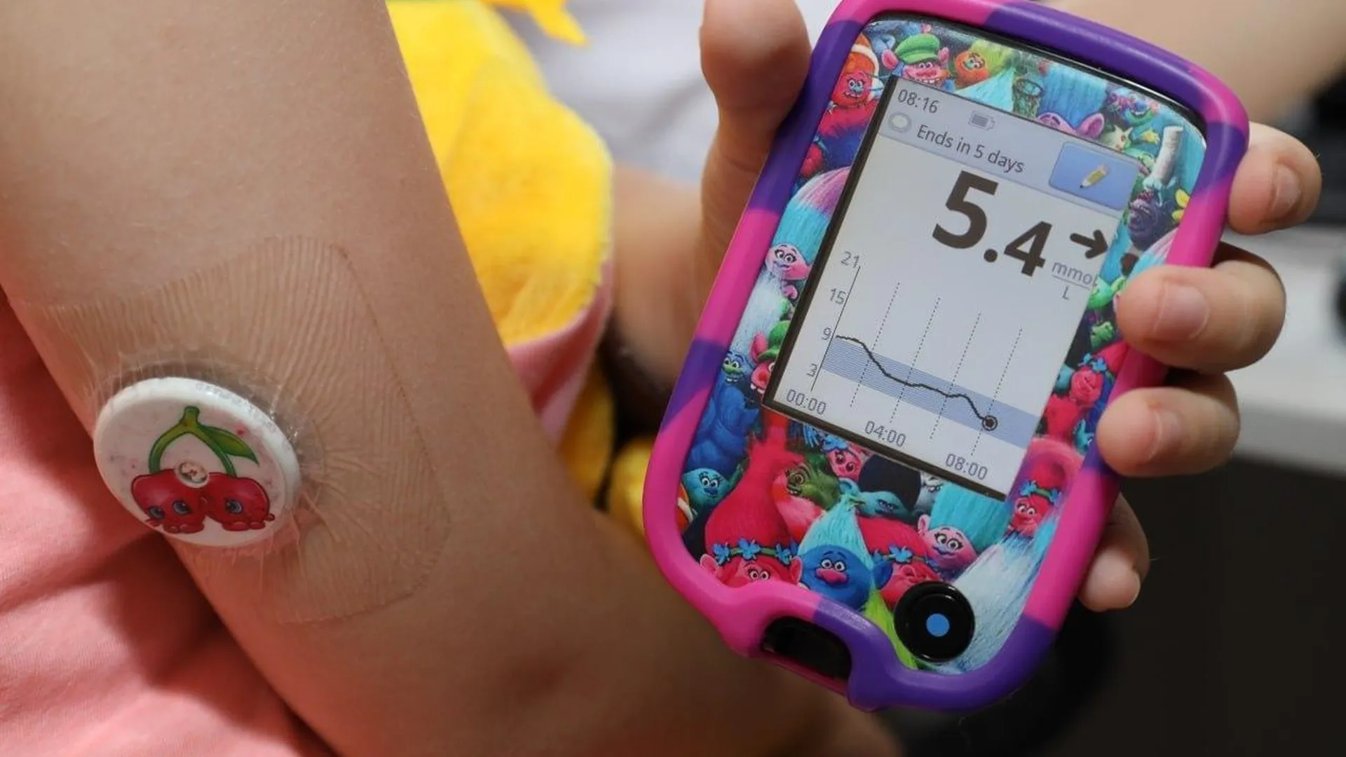 2,5 тыс детей с диабетом обеспечивают мониторингом глюкозы в Подмосковье
