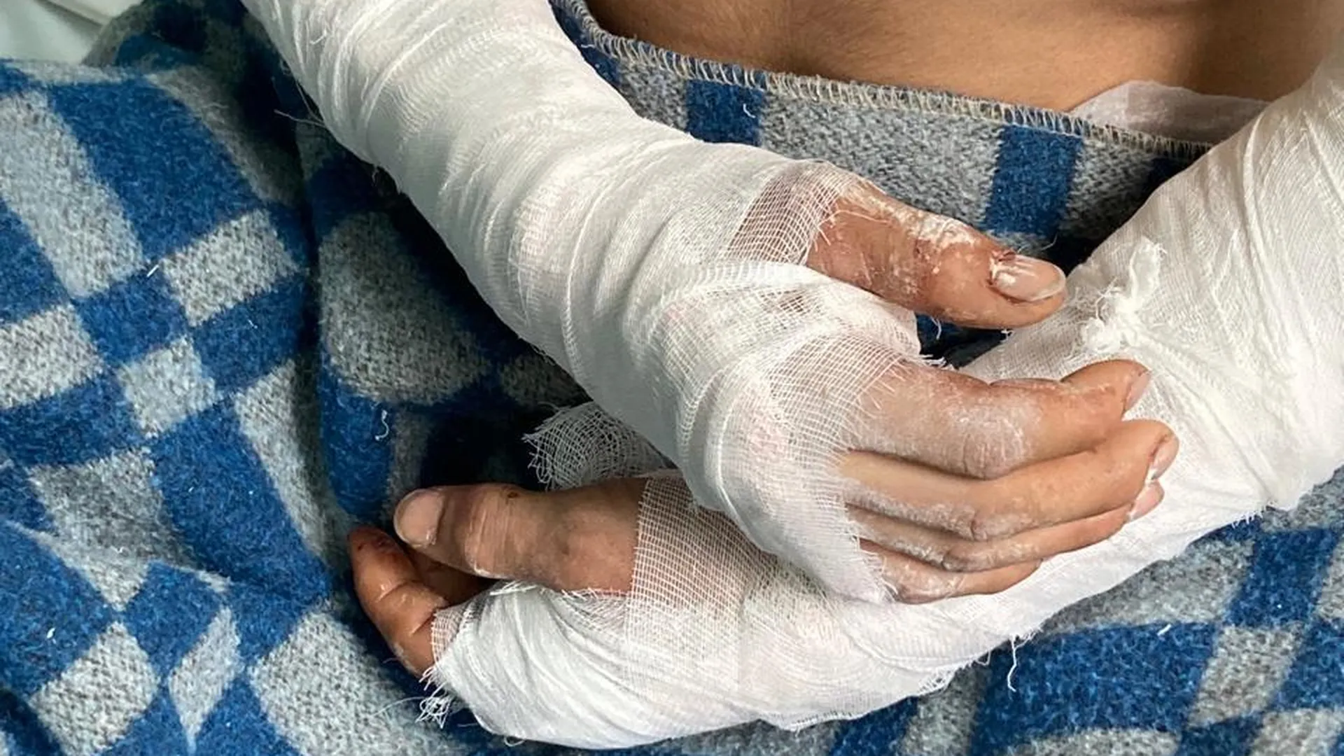 Солнечногорские хирурги пришили мужчине обе руки, отрезанные стеклом