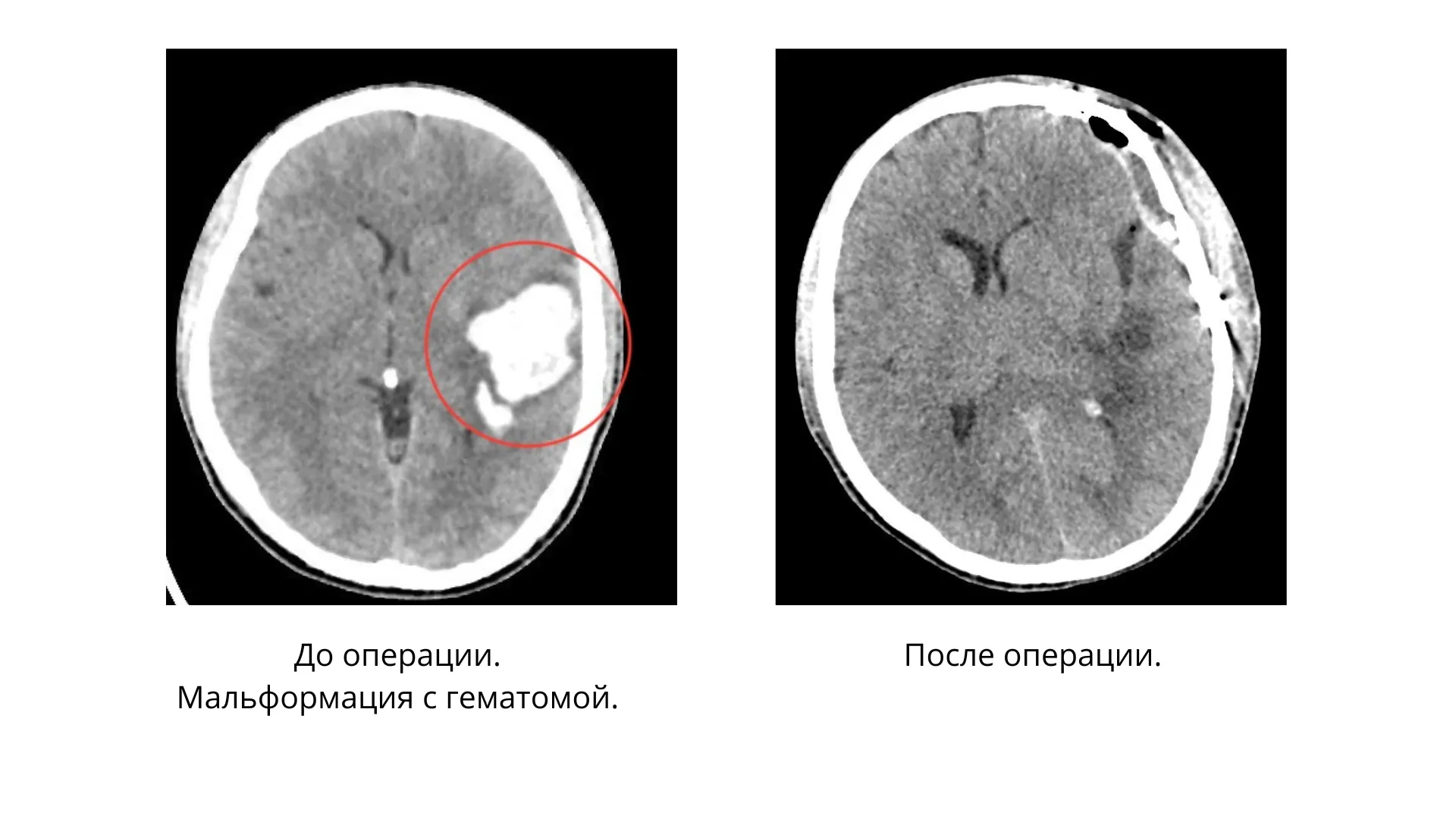 Врачи МОНИКИ удалили 18-летнему пациенту гематому в мозге | РИАМО