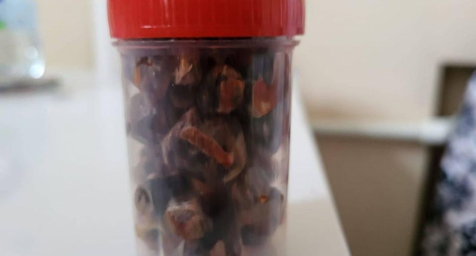Врачи Домодедовской больницы извлекли из желчного пузыря пациентки стакан камней