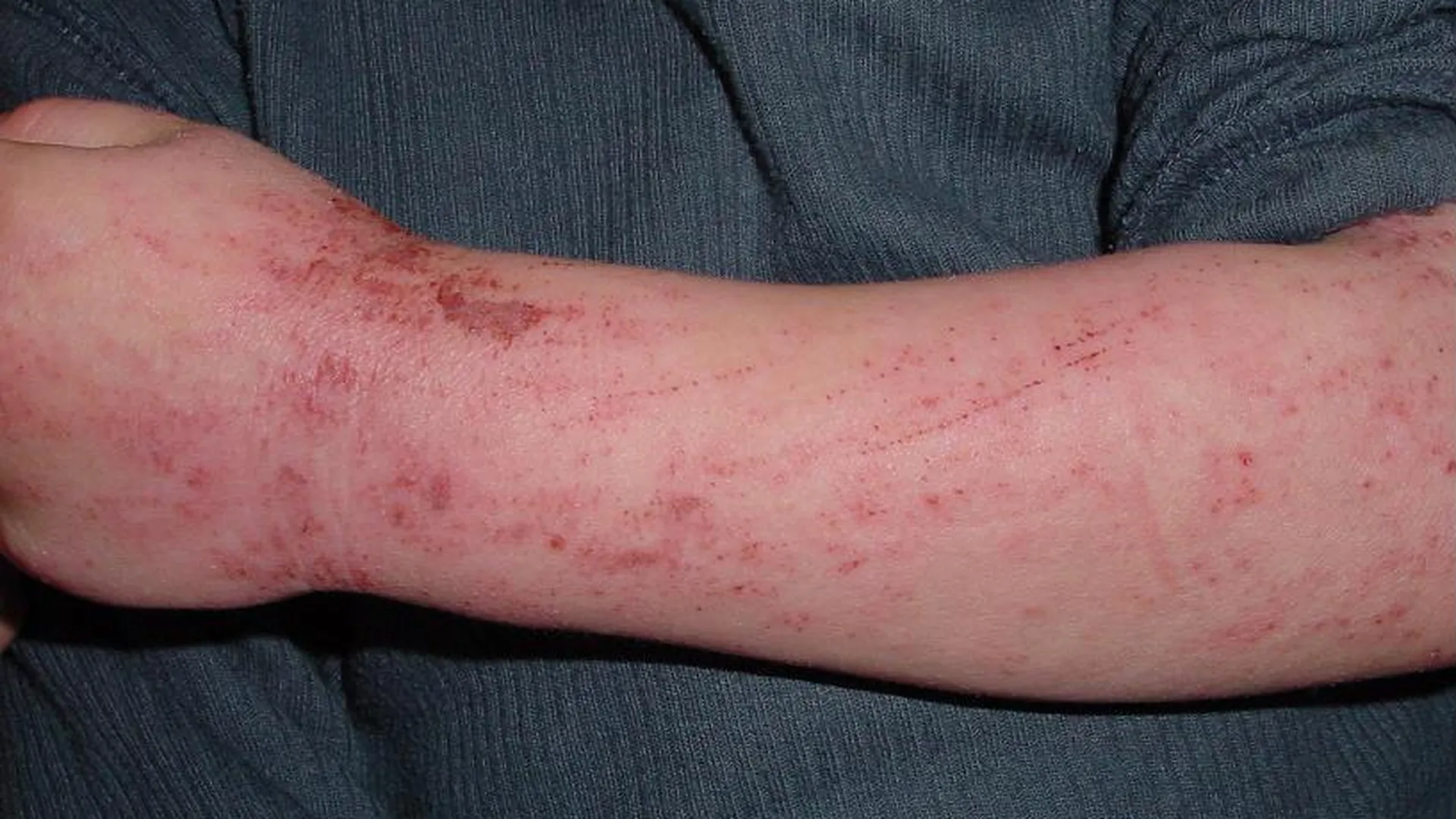 Neurodermitis am Arm eines 5-jährigen Kindes, Википедия