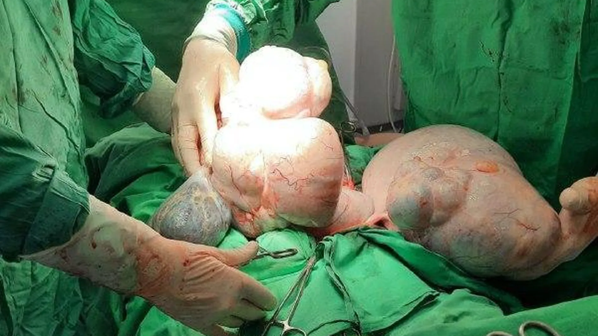 Подмосковные врачи спасли женщину с двумя опухолями яичников весом почти 20 кг