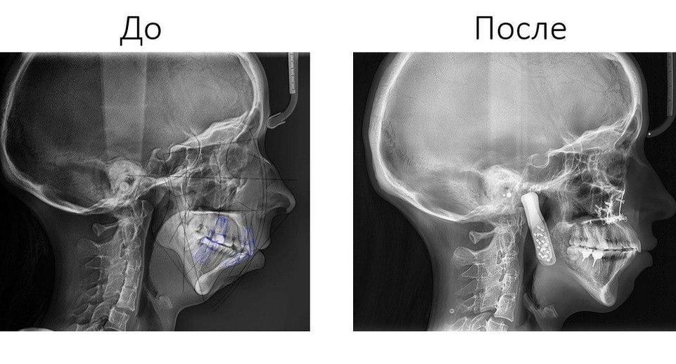 Хирурги МОНИКИ 12 часов восстанавливали челюсть пациентке по 3D-модели